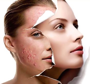 Geladen vers munt 13 Tips for the Treatment of Acne - Platinum Skin Care
